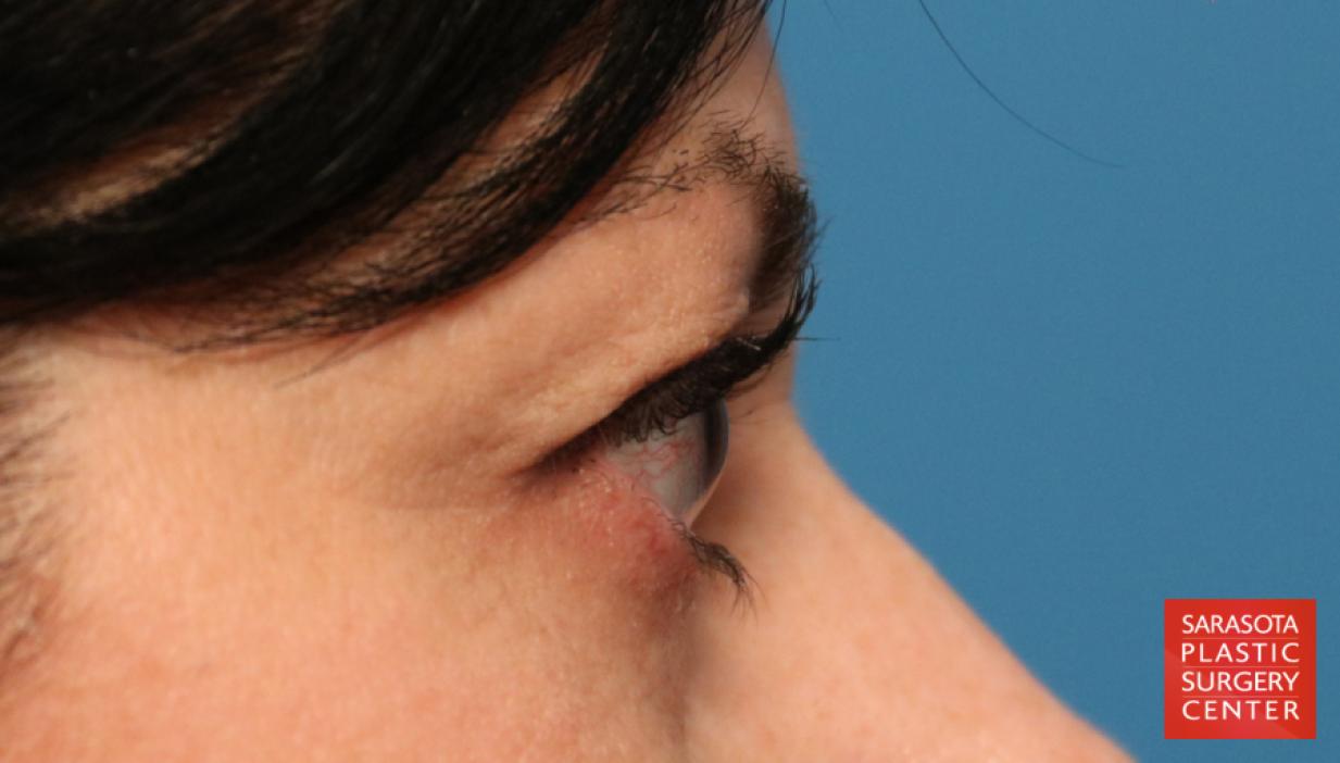 Eyelid Lift: Patient 14 - Before and After 3