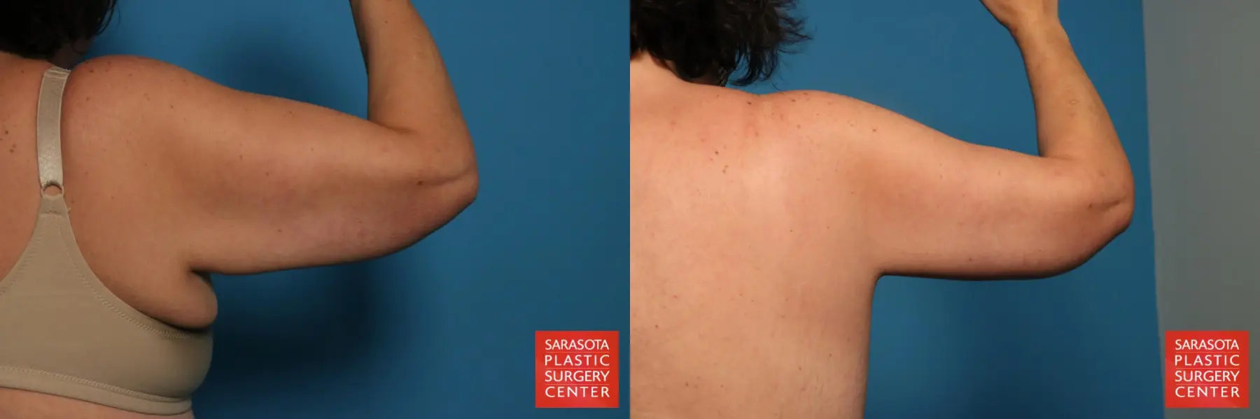 Arm Lift: Patient 11 - Before and After 6
