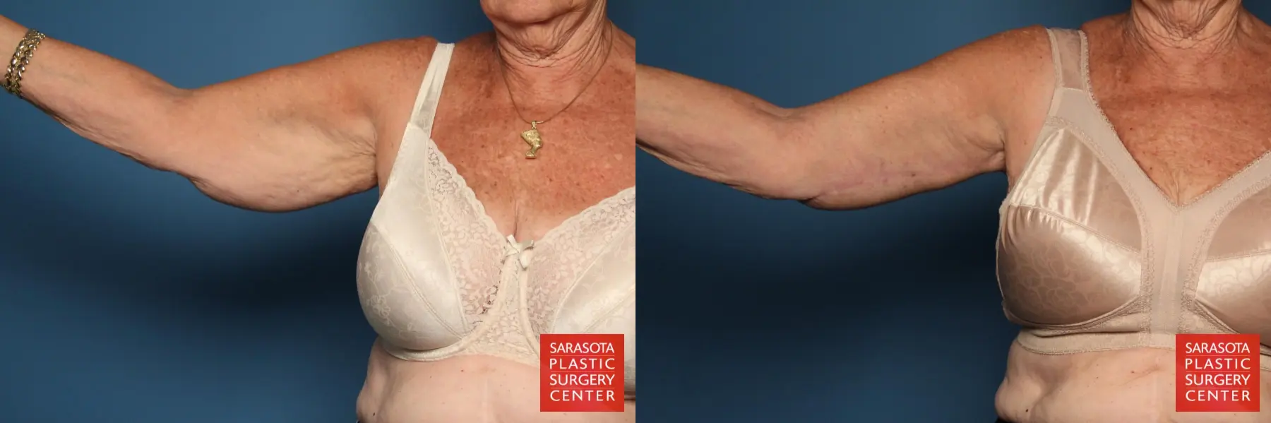 Arm Lift: Patient 5 - Before and After 1