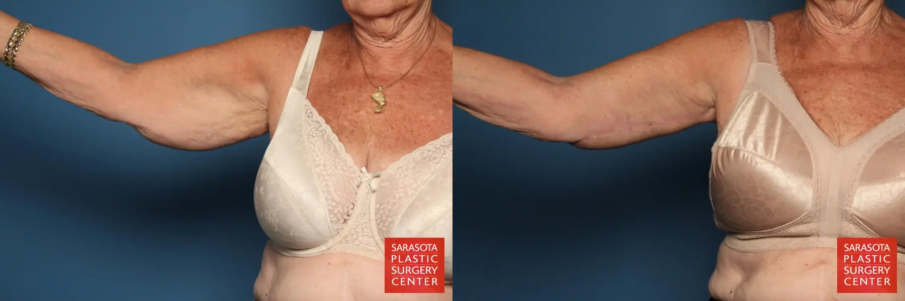 Arm Lift: Patient 5 - Before and After  