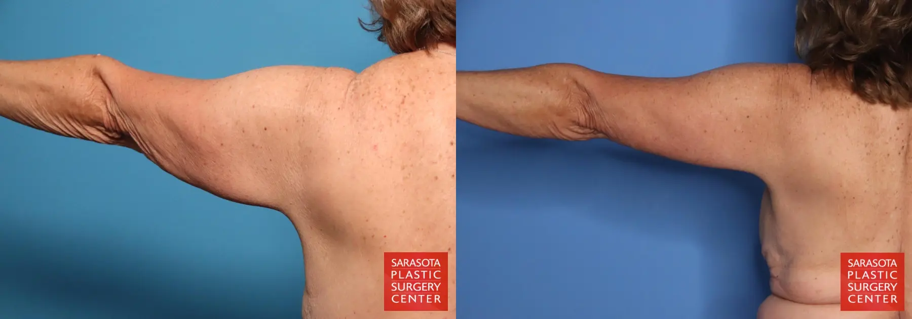Arm Lift: Patient 9 - Before and After 5