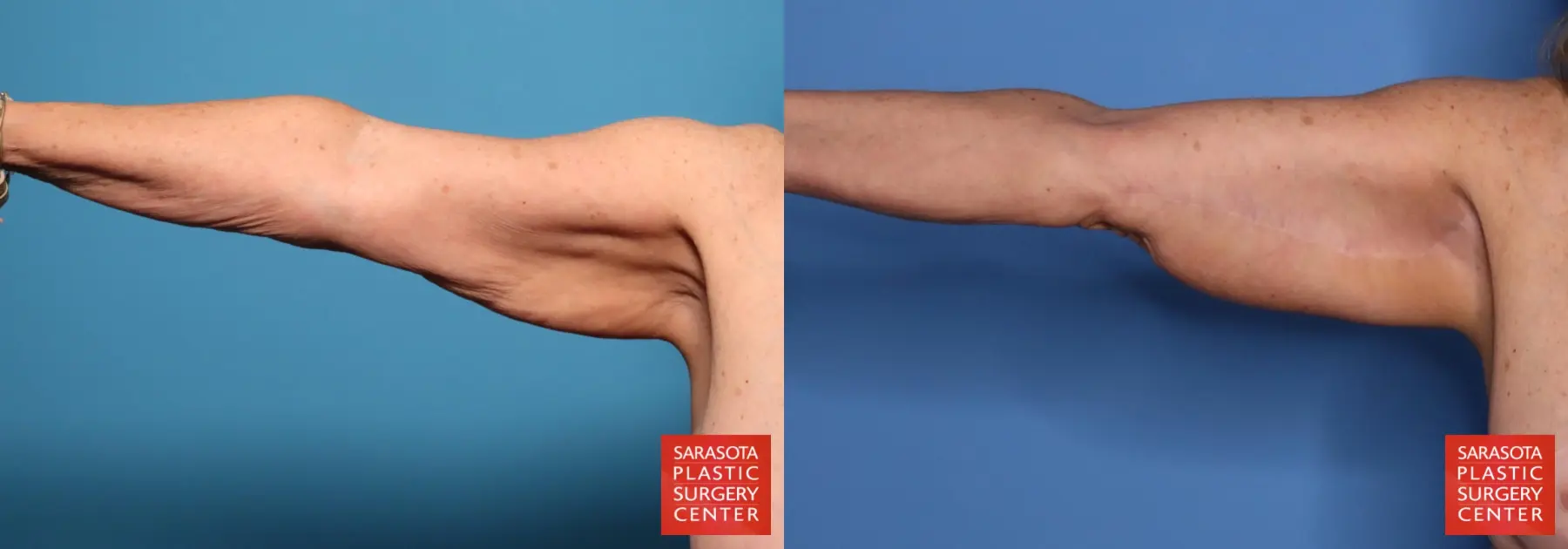 Arm Lift: Patient 9 - Before and After  