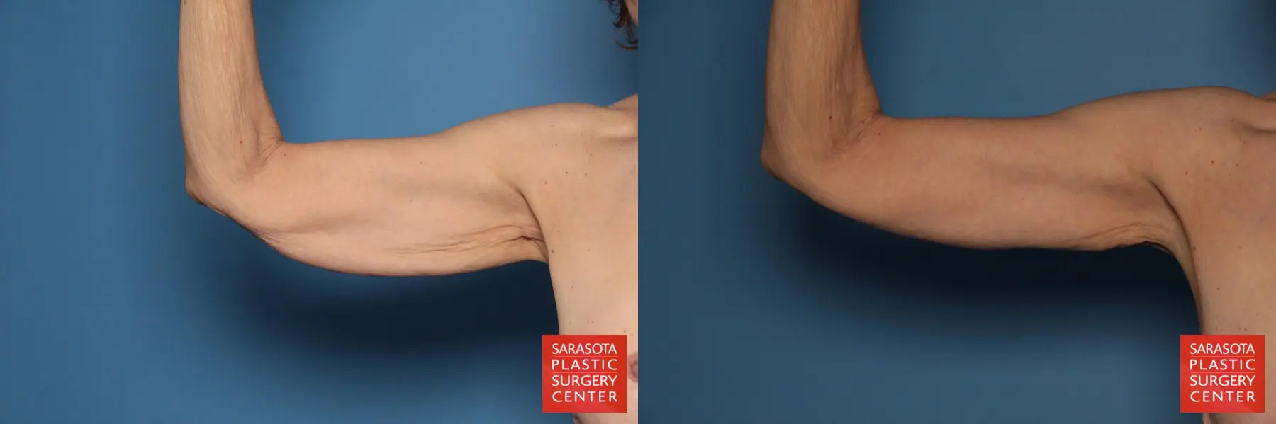 Arm Lift: Patient 7 - Before and After  