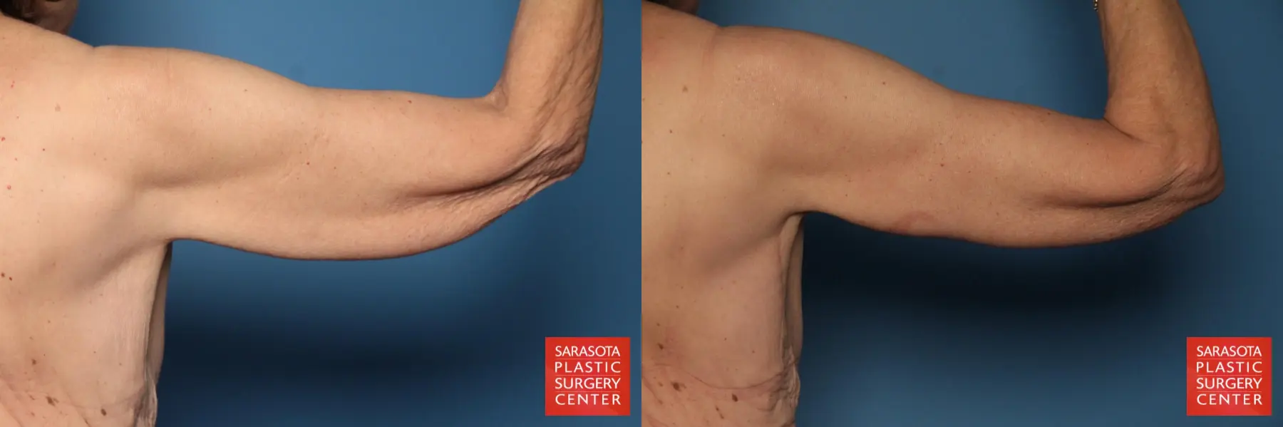Arm Lift: Patient 7 - Before and After 4