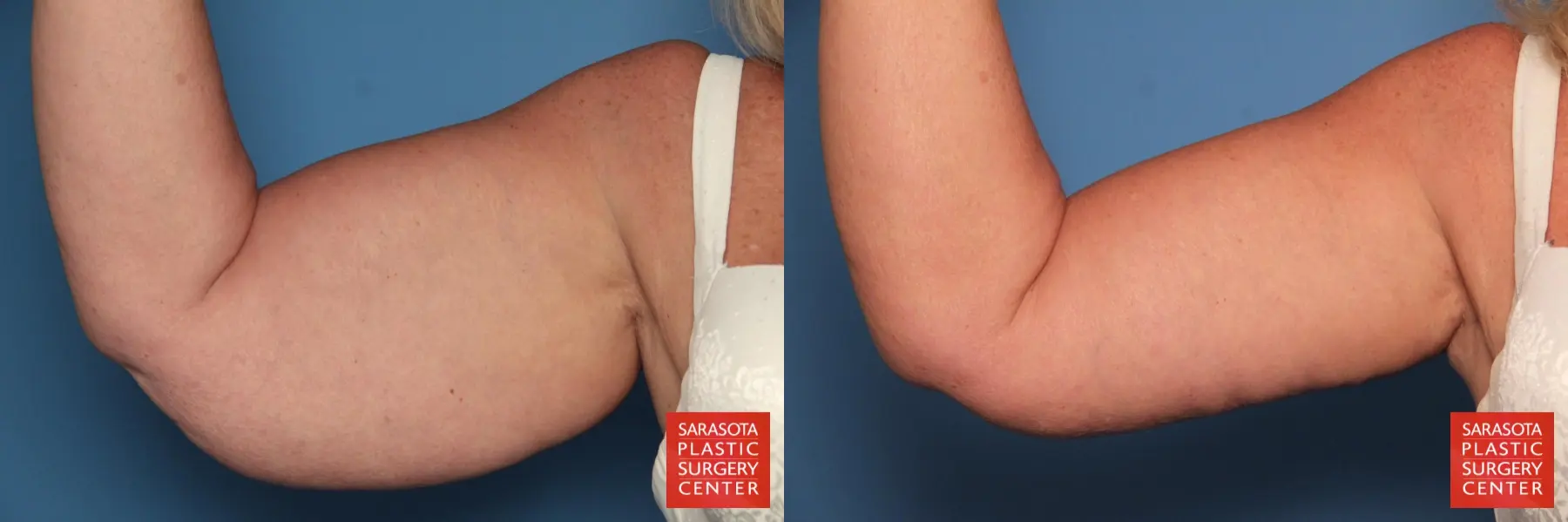 Arm Lift: Patient 1 - Before and After  