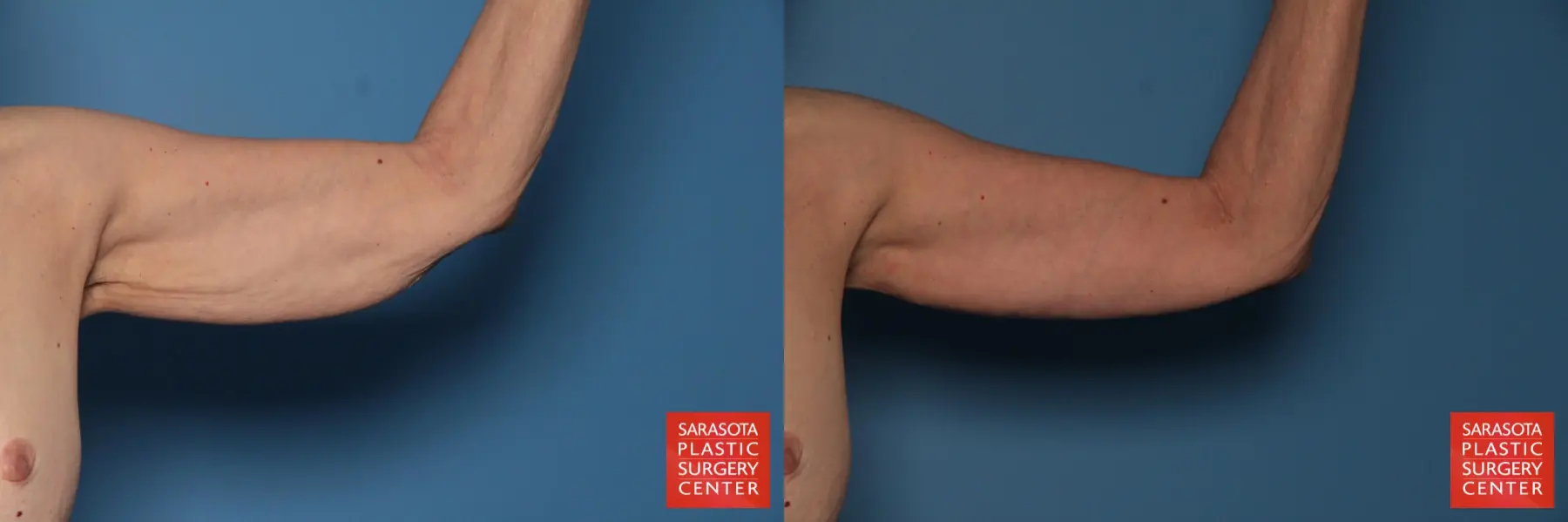 Arm Lift: Patient 7 - Before and After 2