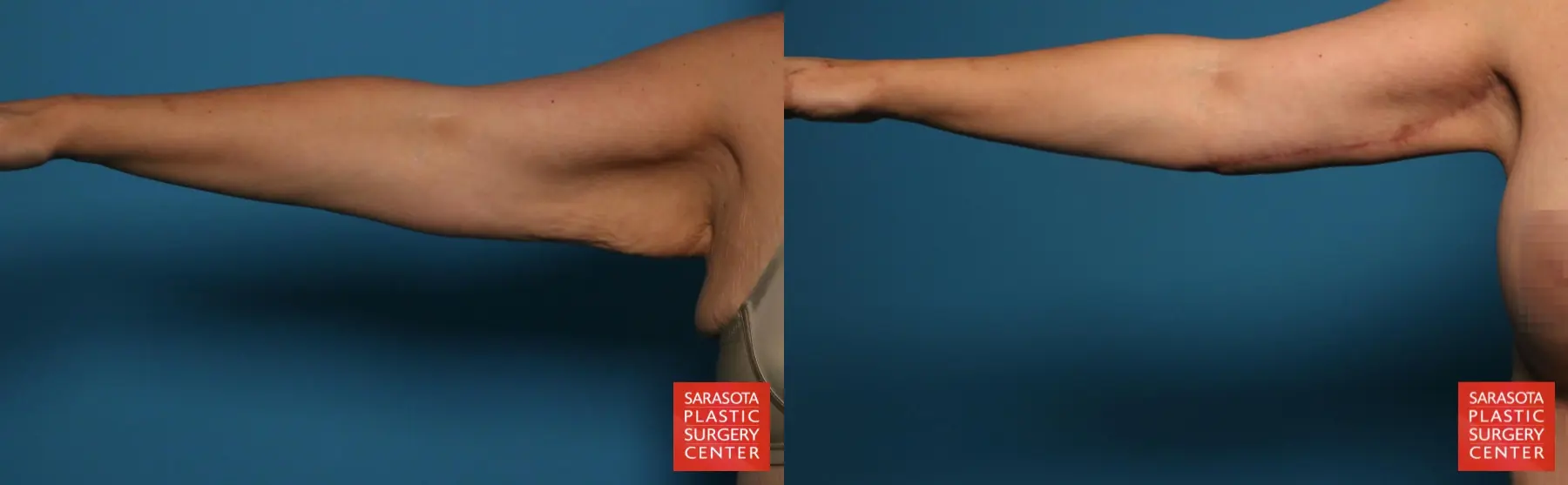 Arm Lift: Patient 11 - Before and After 1