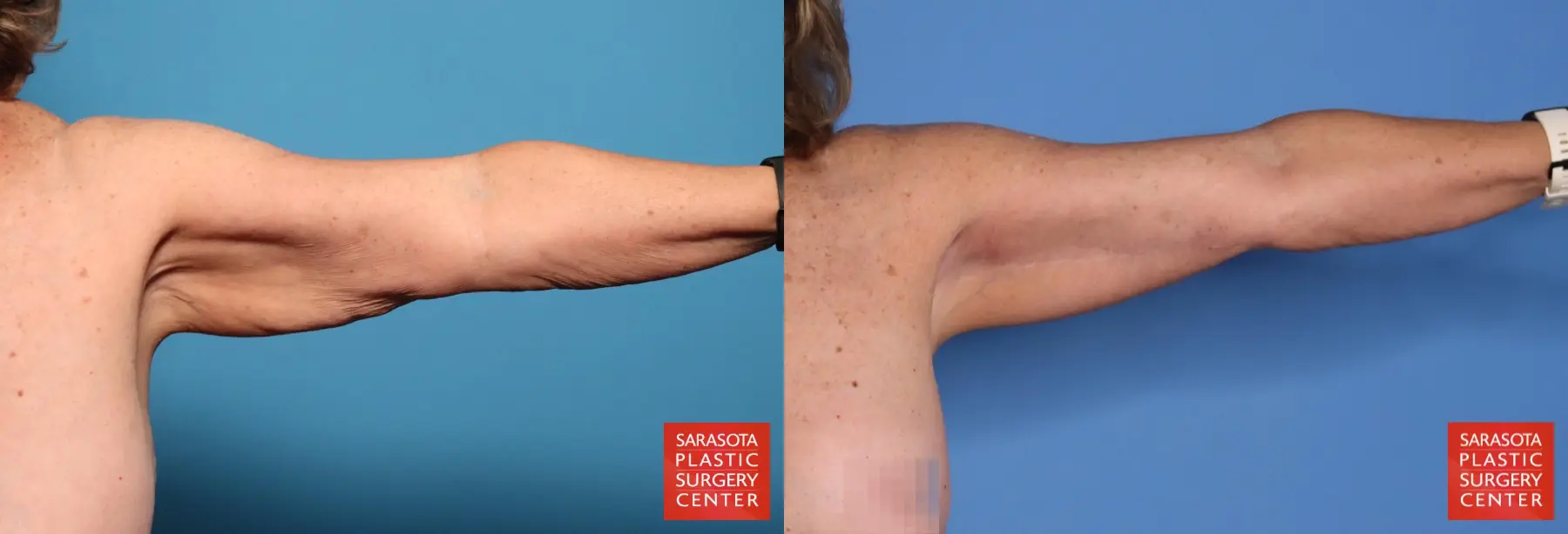 Arm Lift: Patient 9 - Before and After 3