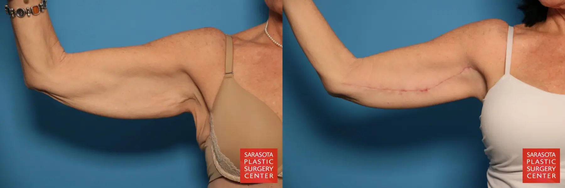 Arm Lift: Patient 19 - Before and After  