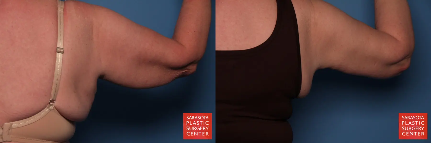 Arm Lift: Patient 10 - Before and After 4