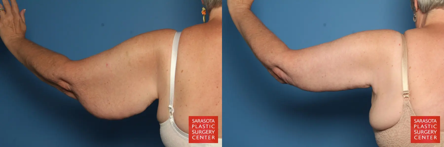 Arm Lift: Patient 4 - Before and After 3