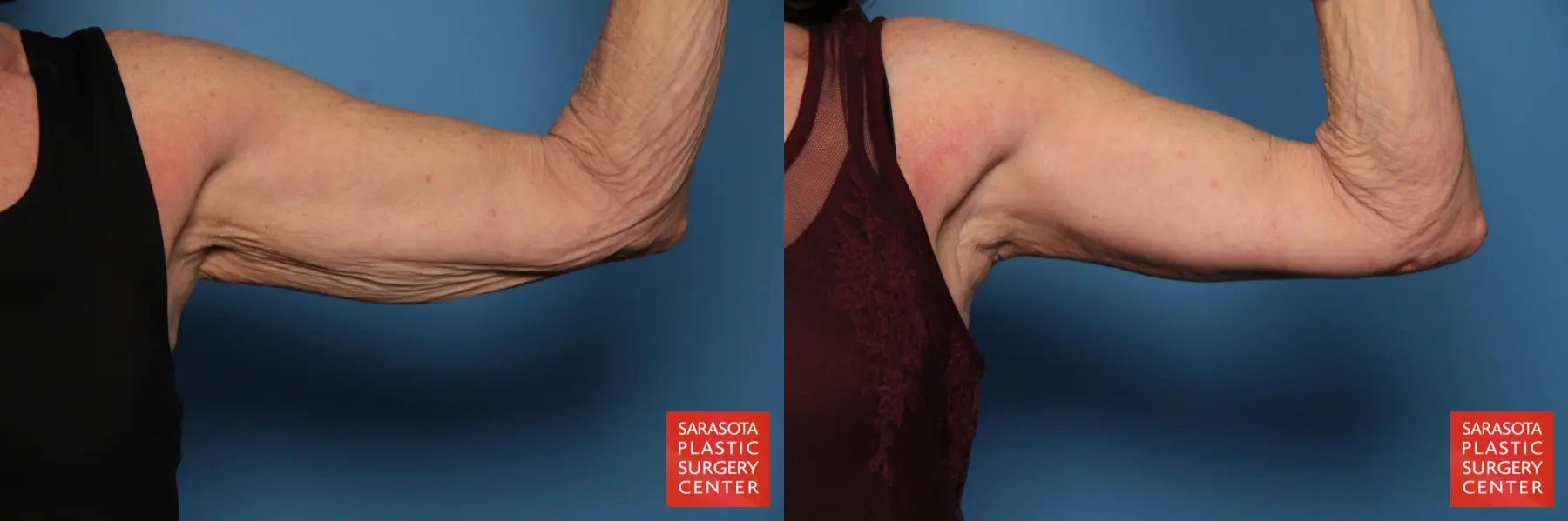 Arm Lift: Patient 5 - Before and After 2