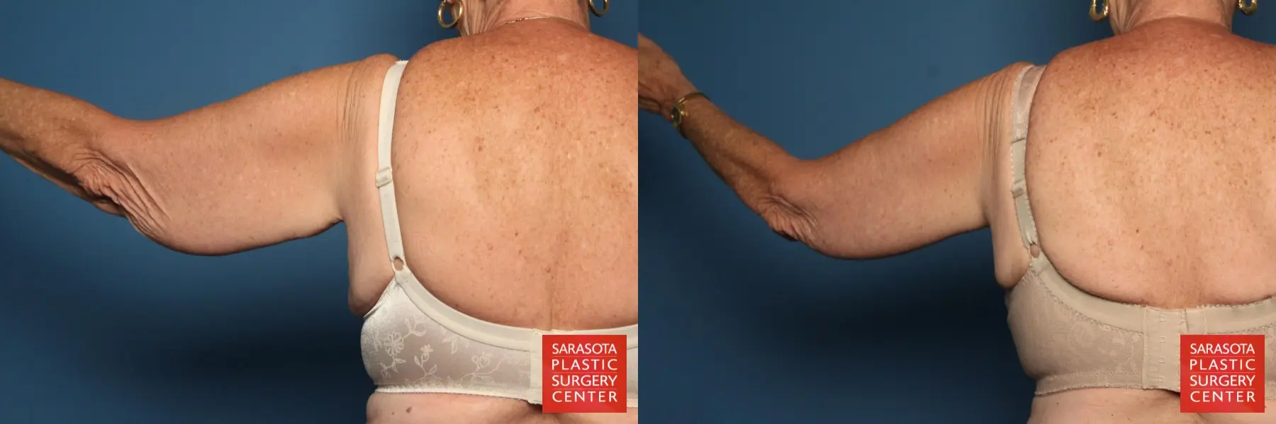 Arm Lift: Patient 9 - Before and After 4