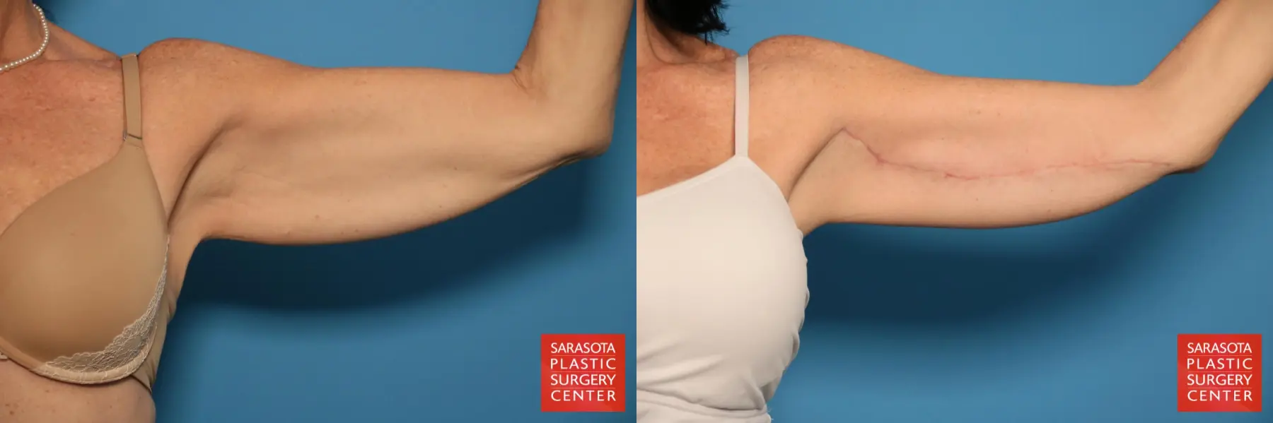 Arm Lift: Patient 6 - Before and After 2