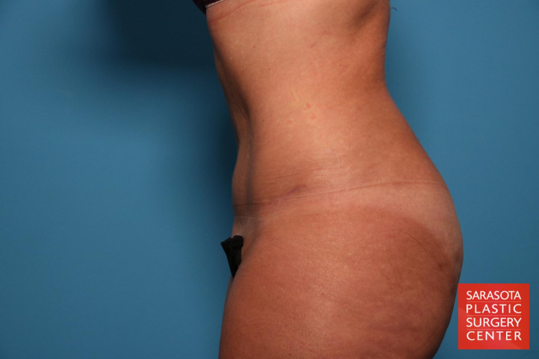 Tummy Tuck: Patient 1 - After 3