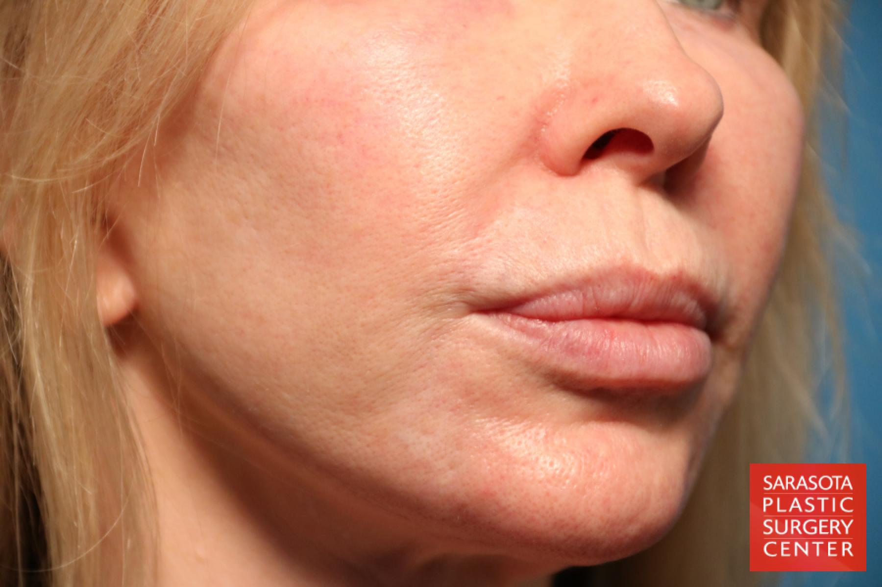 Laser Skin Resurfacing - Face: Patient 7 - Before and After 3