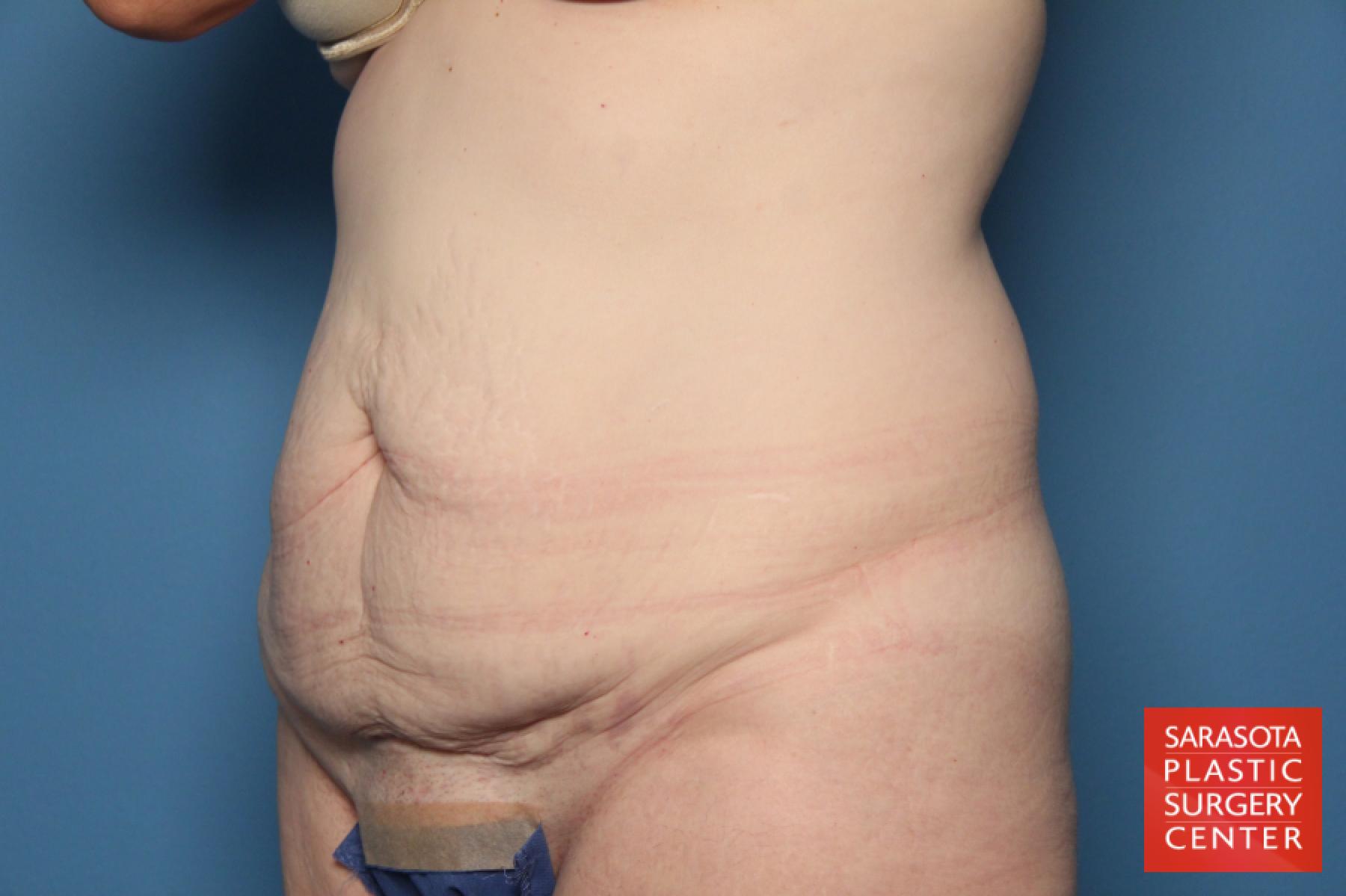 Tummy Tuck: Patient 17 - Before 2