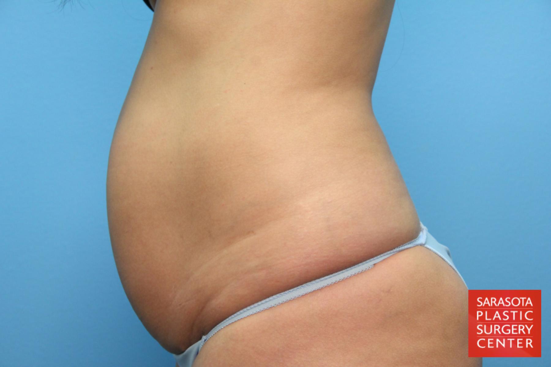 Tummy Tuck: Patient 12 - Before 3