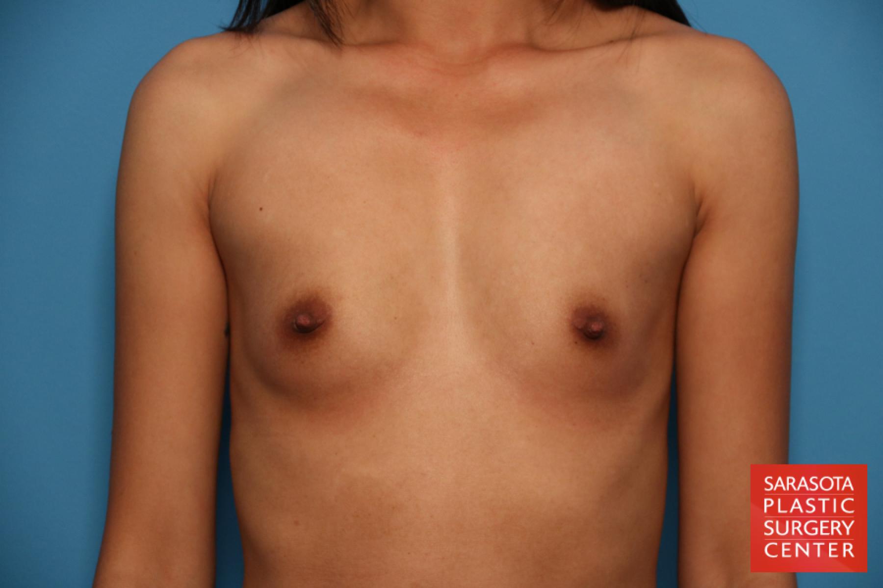 Breast Augmentation: Patient 39 - Before 1