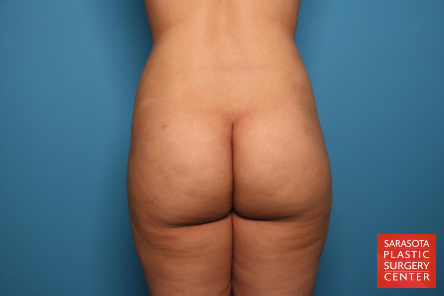 Liposuction: Patient 15 - After 4