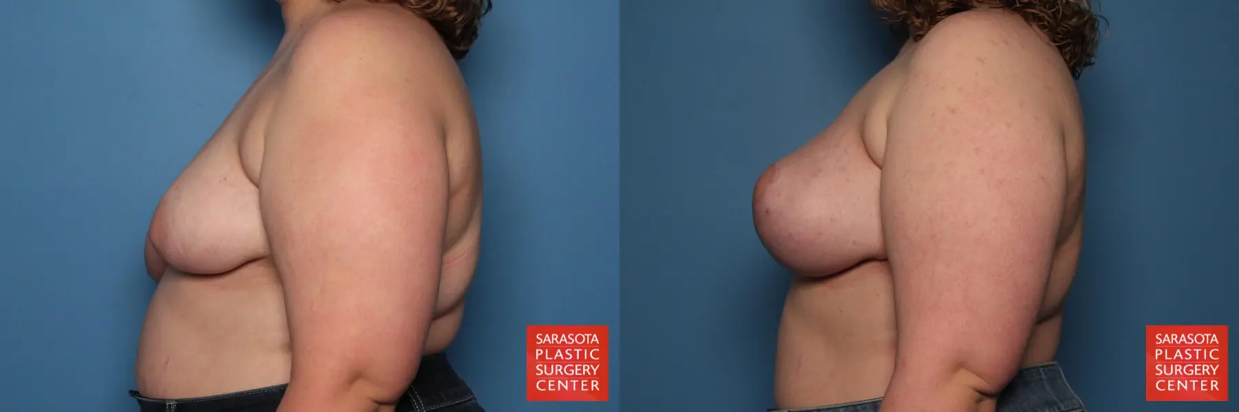 Breast Asymmetry: Patient 1 - Before and After 3