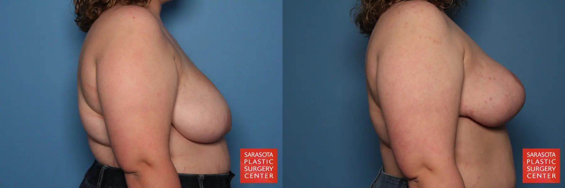 Breast Asymmetry: Patient 1 - Before and After 4
