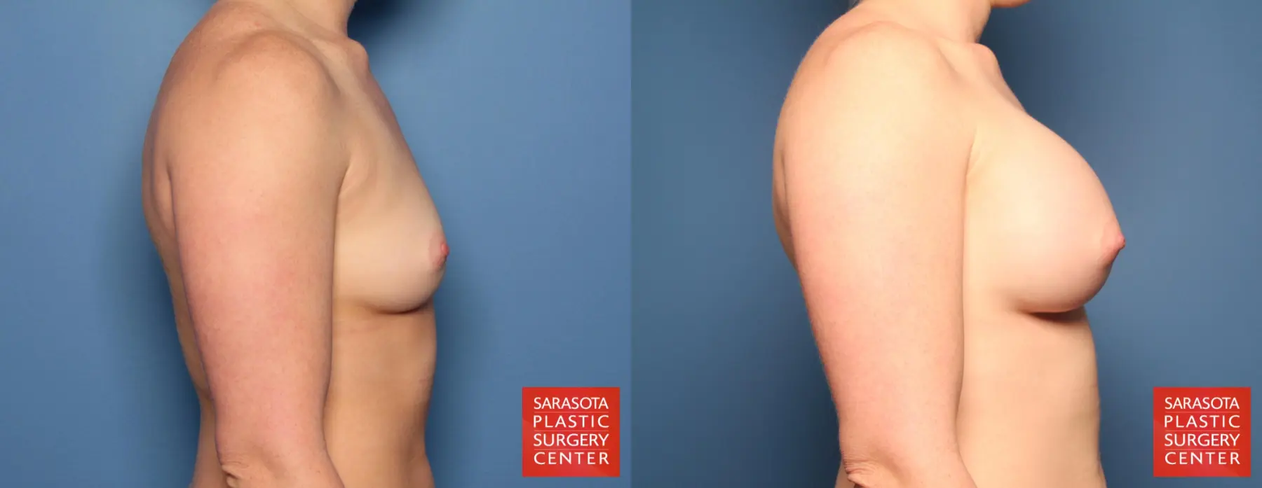Breast Augmentation: Patient 84 - Before and After 3