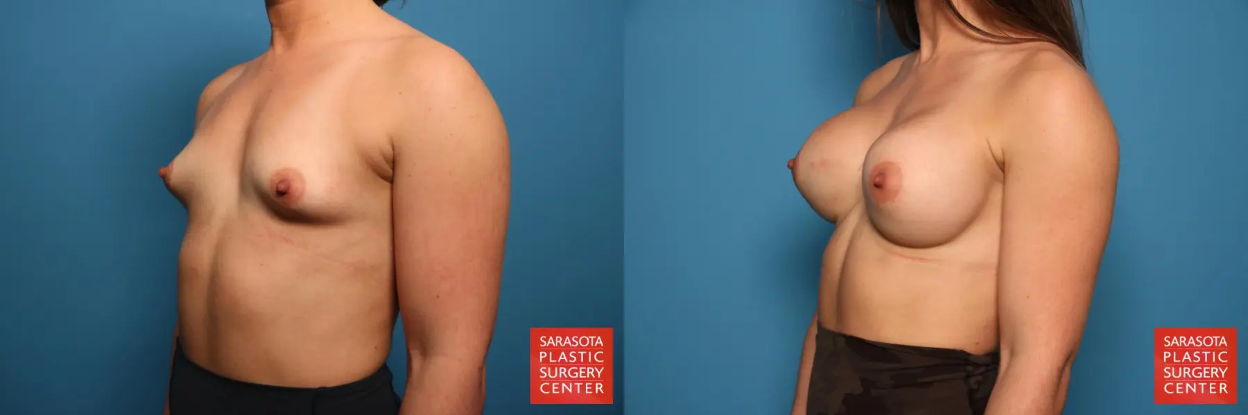 Breast Augmentation: Patient 64 - Before and After 2
