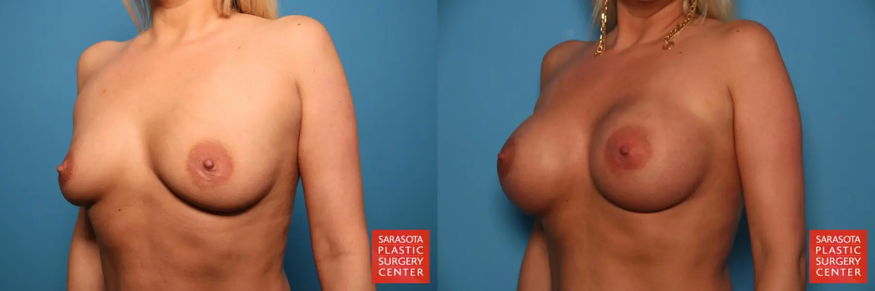 Breast Augmentation: Patient 57 - Before and After 2