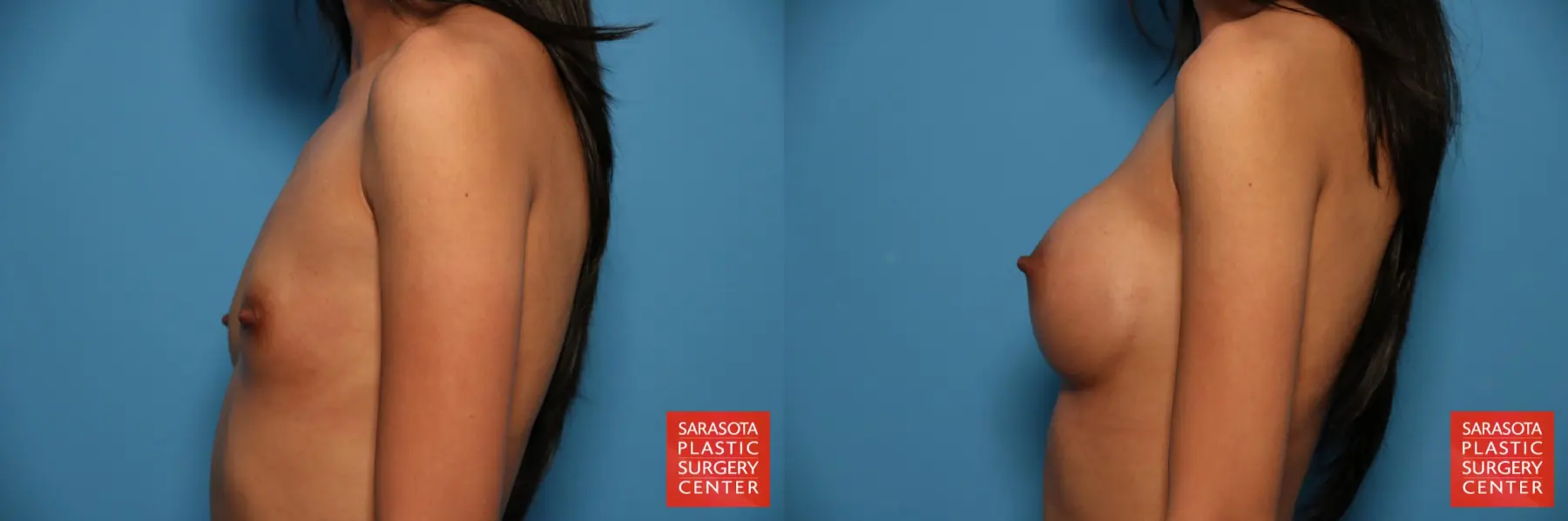 Breast Augmentation: Patient 39 - Before and After 3