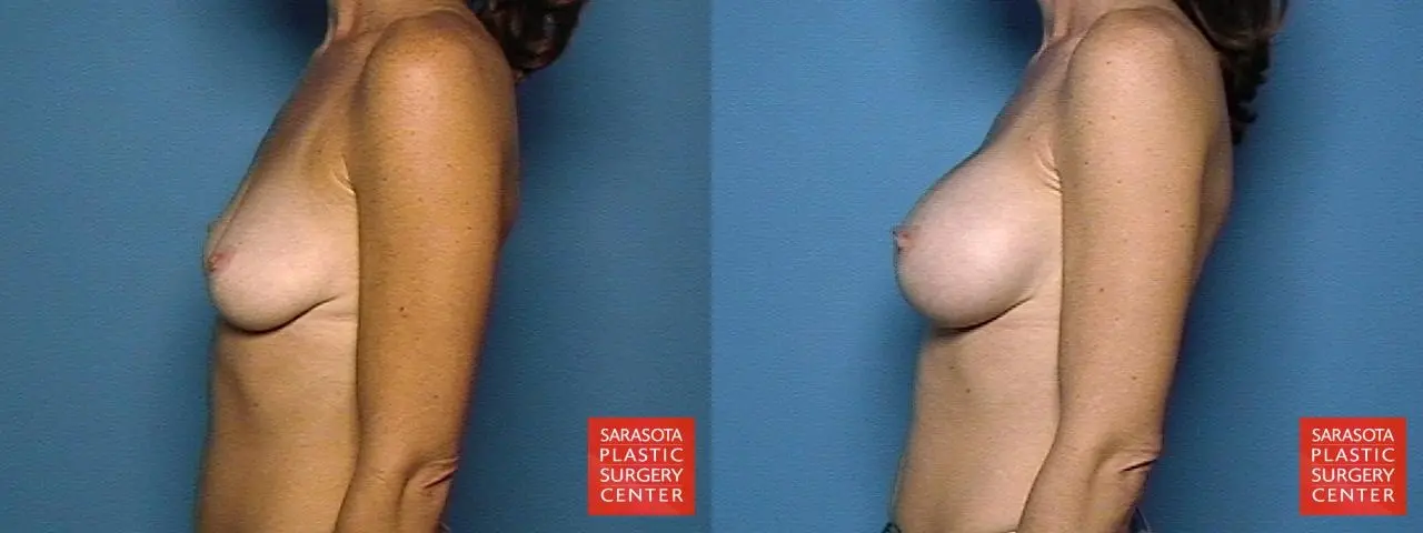 Breast Augmentation: Patient 37 - Before and After 3