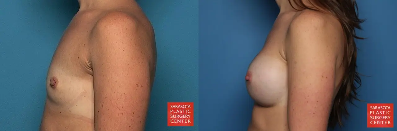 Breast Augmentation: Patient 24 - Before and After 3