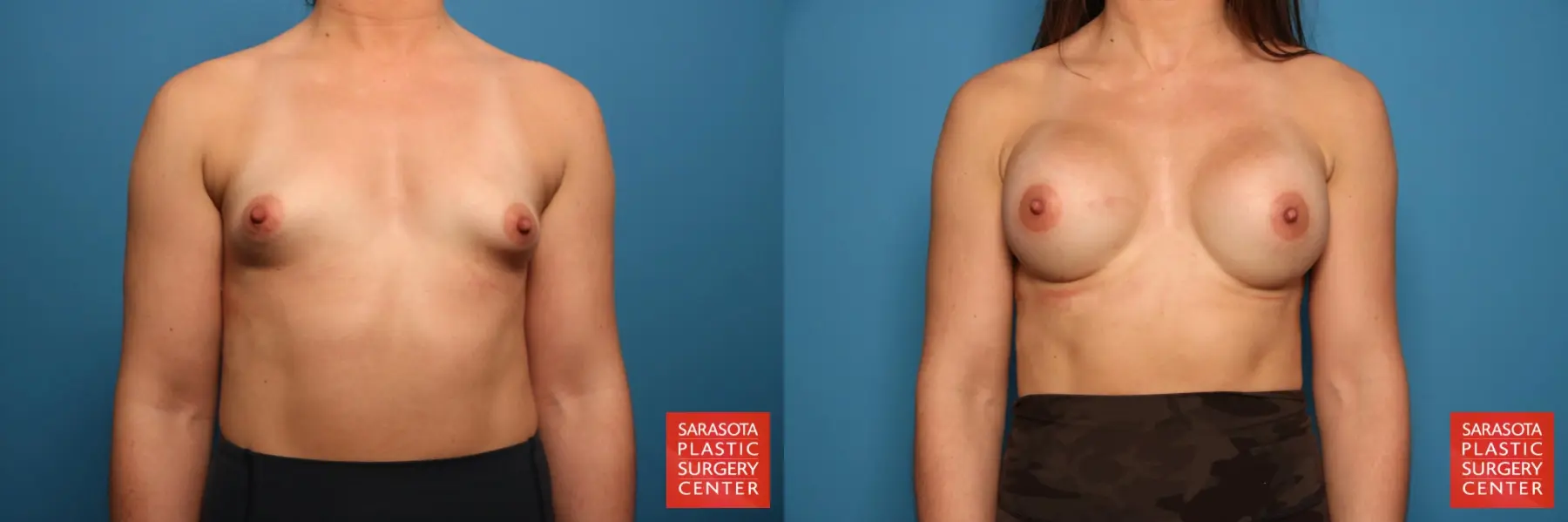Breast Augmentation: Patient 64 - Before and After 1