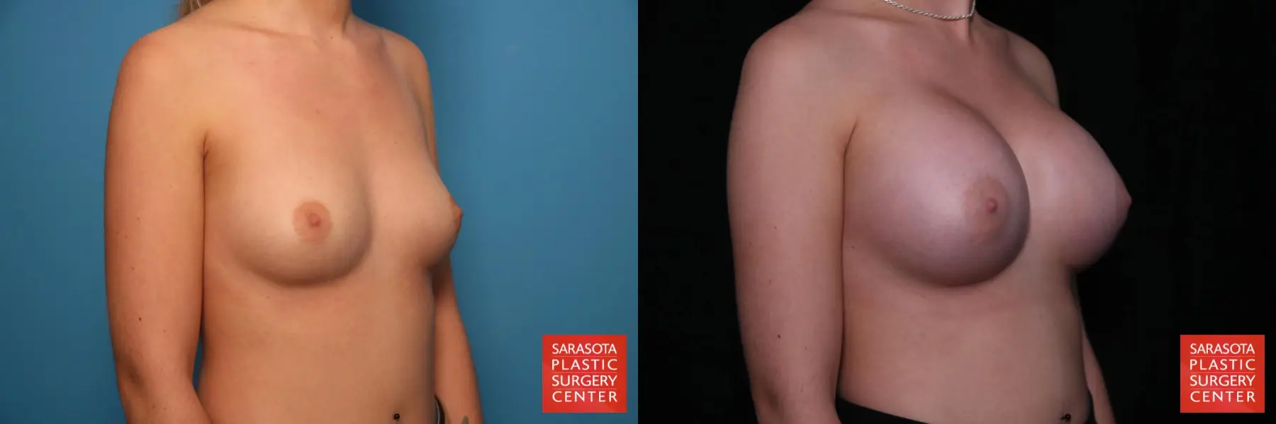 Breast Augmentation: Patient 53 - Before and After 2