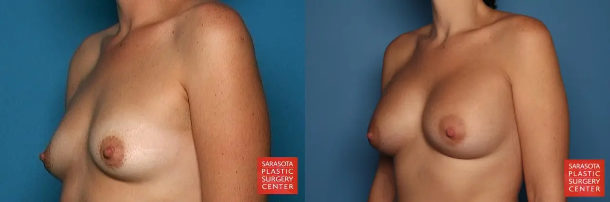 Breast Augmentation: Patient 18 - Before and After 2
