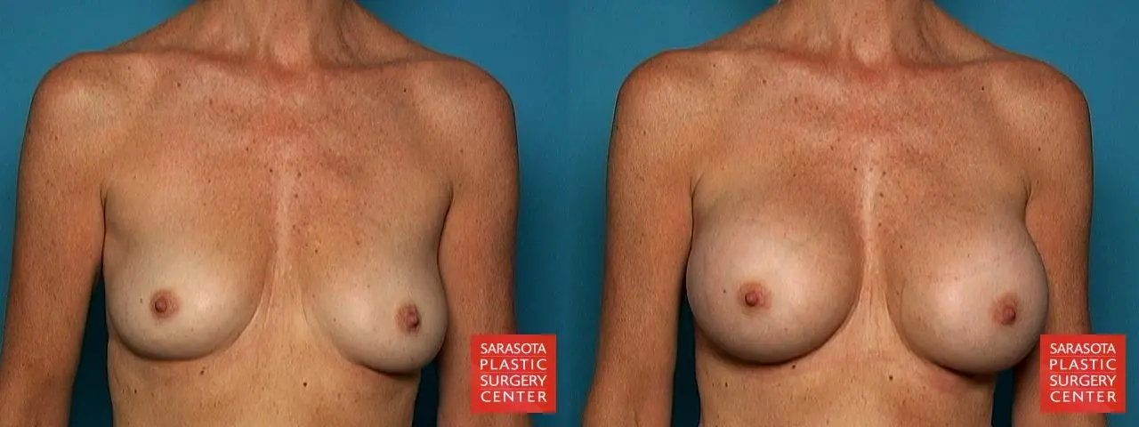 Breast Augmentation: Patient 34 - Before and After 1
