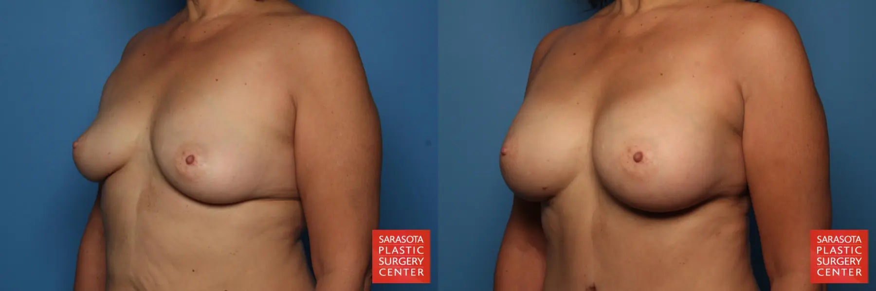Breast Augmentation: Patient 42 - Before and After 2