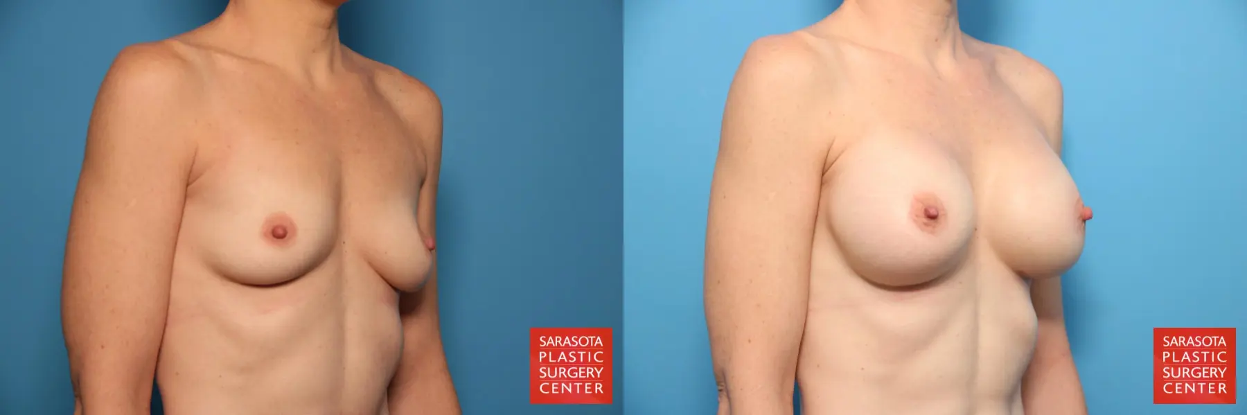Breast Augmentation: Patient 7 - Before and After 4