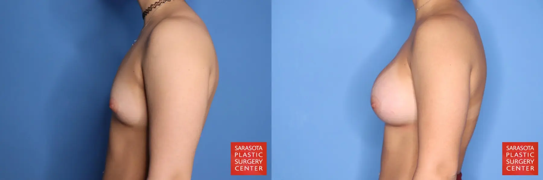 Breast Augmentation: Patient 212 - Before and After 3