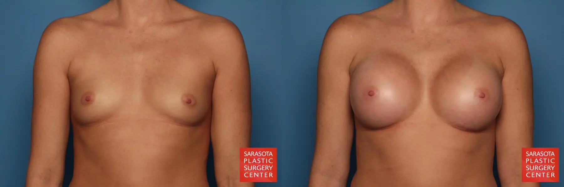 Breast Augmentation: Patient 1 - Before and After  