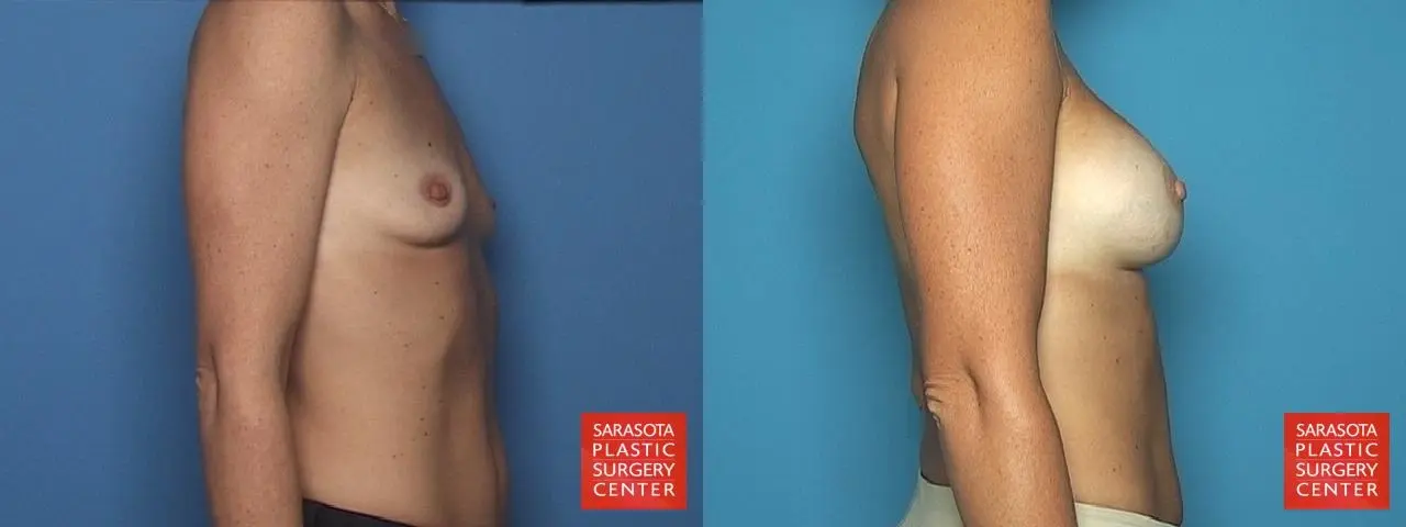 Breast Augmentation: Patient 35 - Before and After 3
