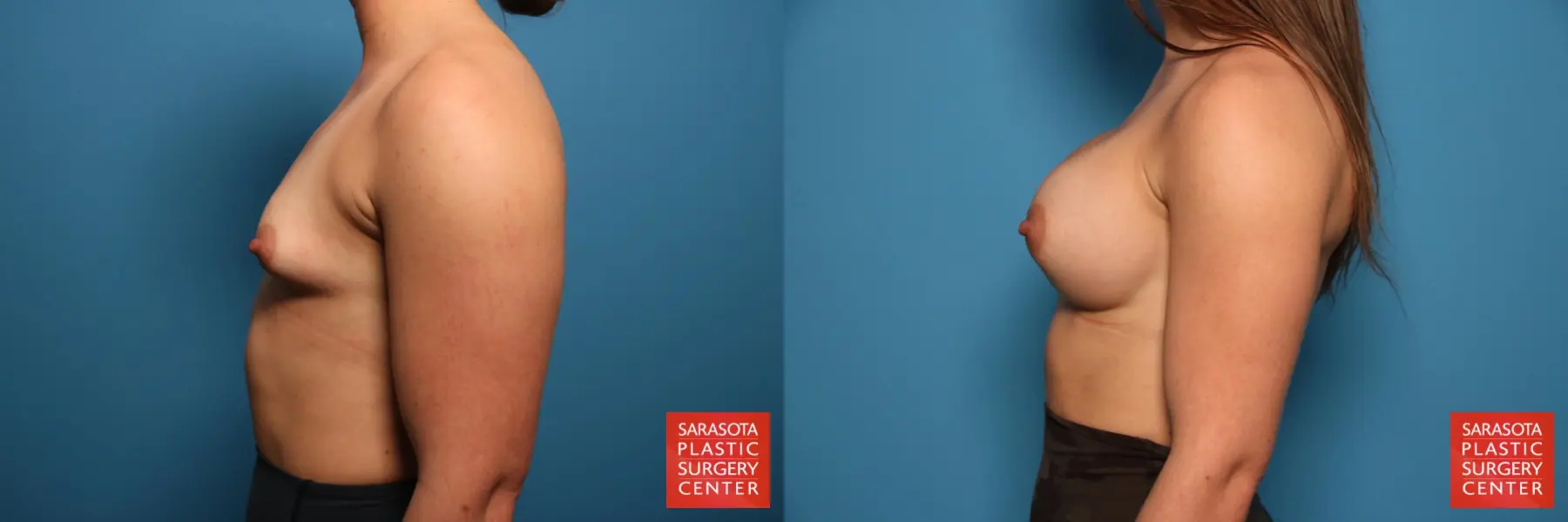 Breast Augmentation: Patient 64 - Before and After 3