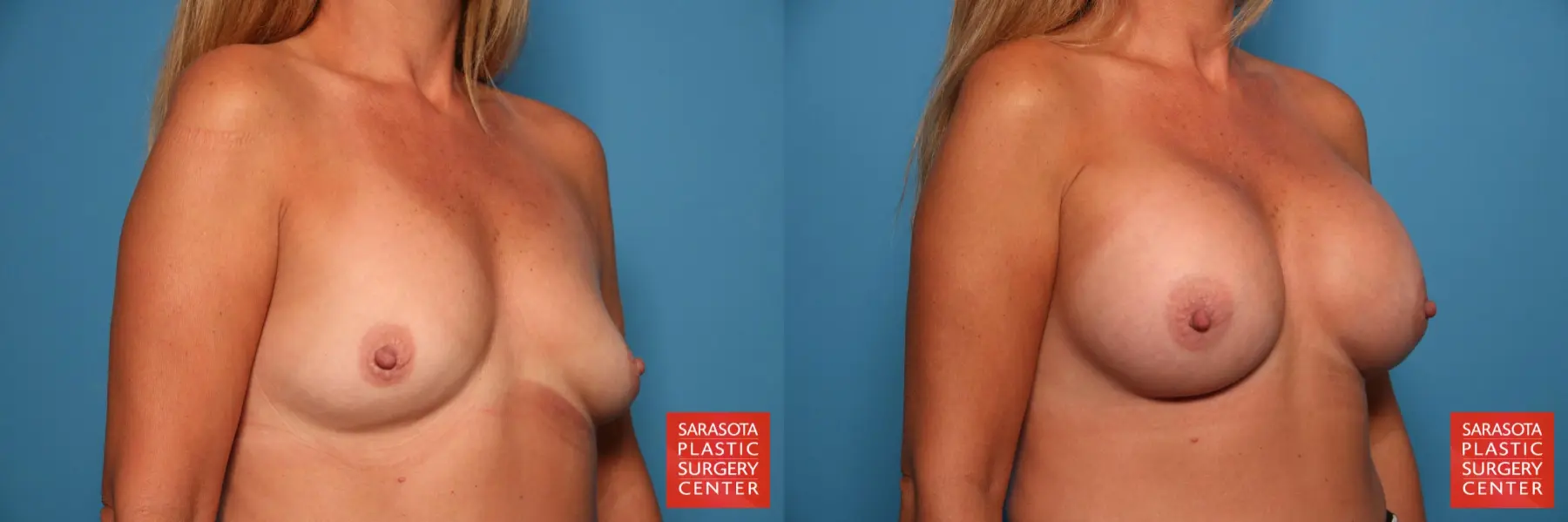 Breast Augmentation: Patient 32 - Before and After 2