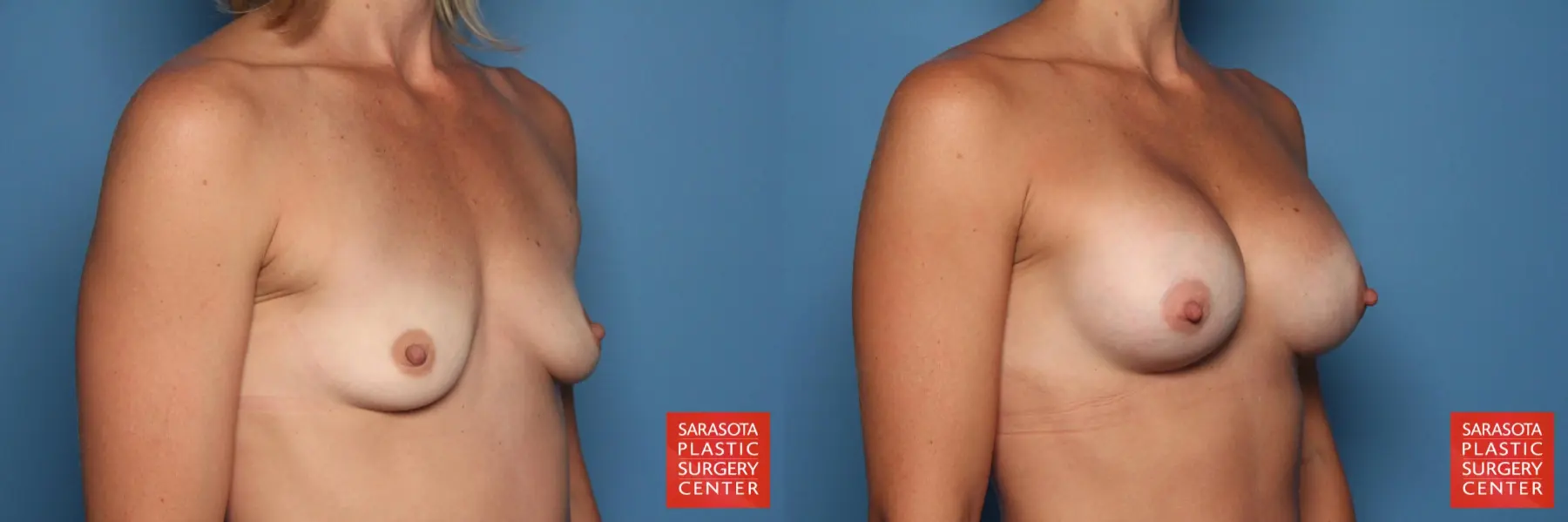Breast Augmentation: Patient 33 - Before and After 4