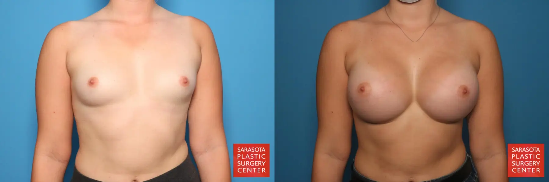 Breast Augmentation: Patient 12 - Before and After  