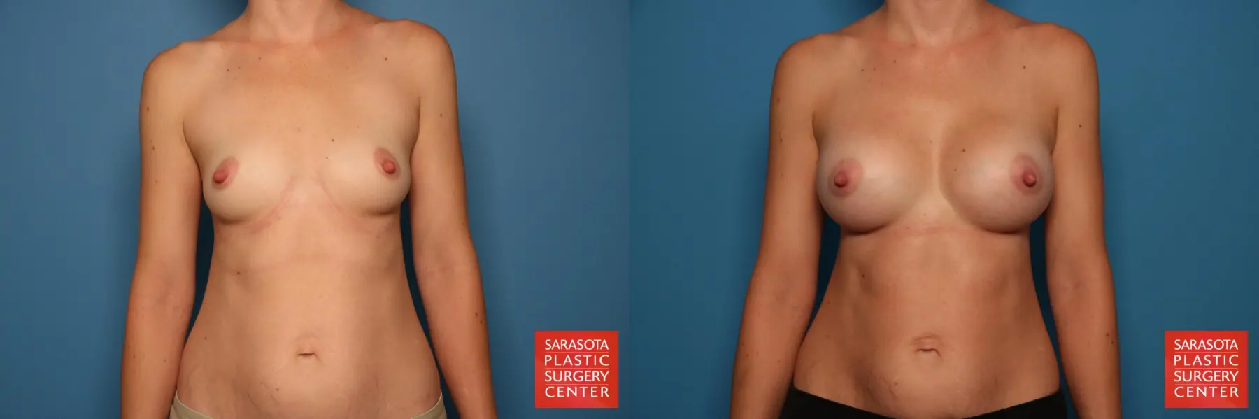 Breast Augmentation: Patient 22 - Before and After 1