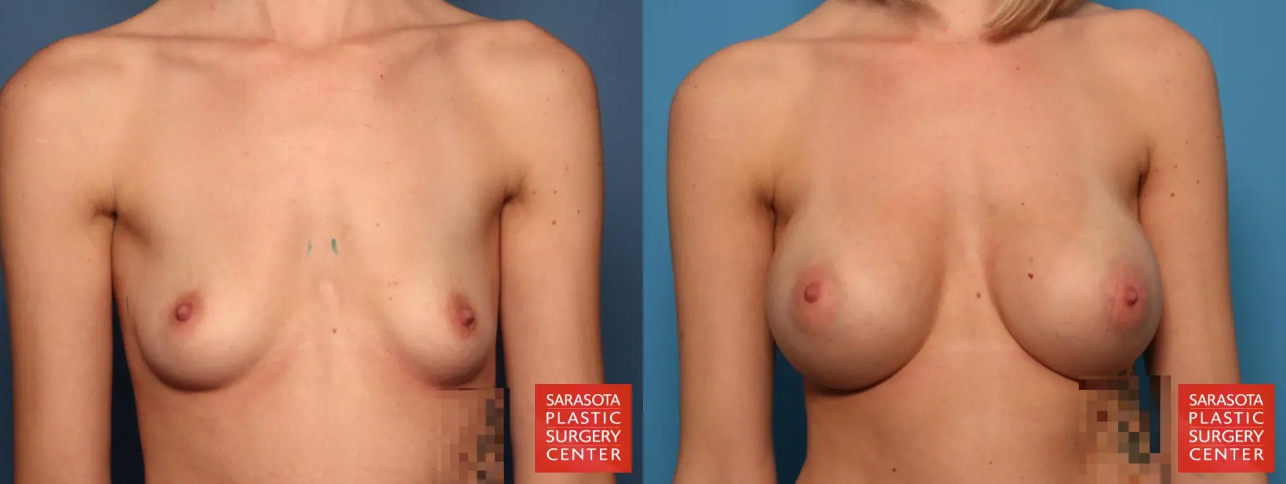 Breast Augmentation: Patient 31 - Before and After 1