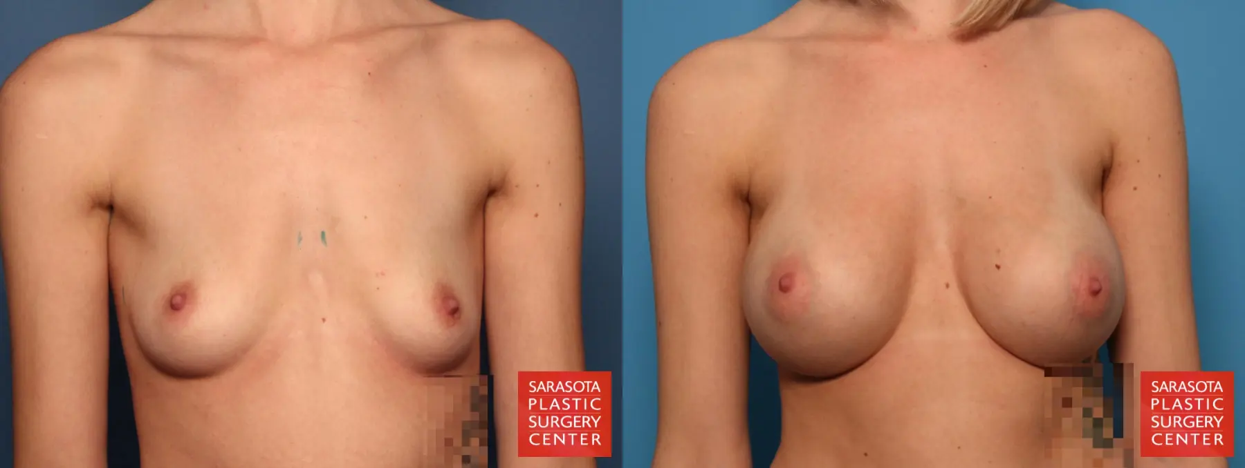 Breast Augmentation: Patient 34 - Before and After  