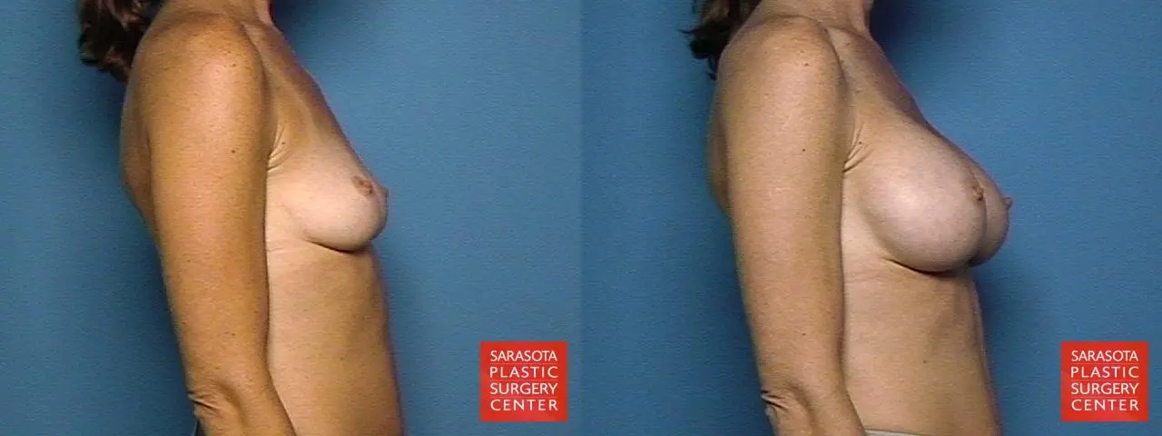 Breast Augmentation: Patient 37 - Before and After 5