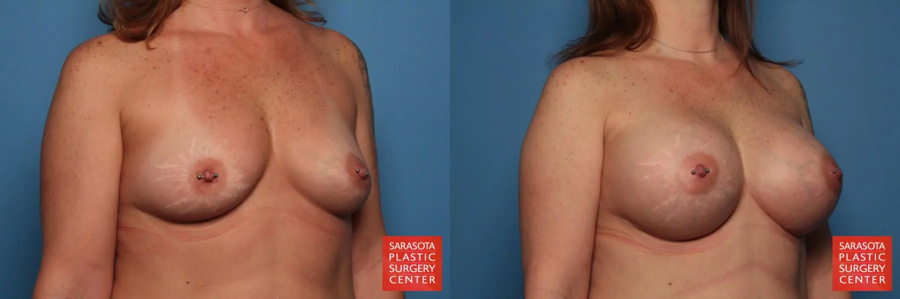 Breast Augmentation: Patient 12 - Before and After 2